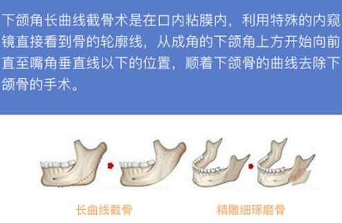 北京联合丽格何照华医生科普下颌整形