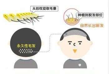 孩子多大可以植发？其实要看是否满足3个关键条件，内附价格表