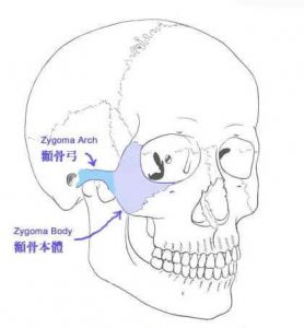 颧骨整形