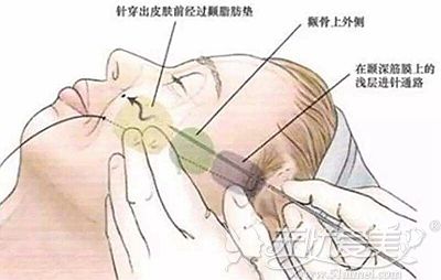 做面部埋线提升前须知美迪塑线和威宁线的区别