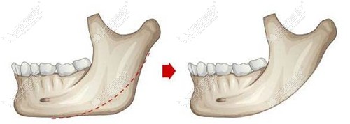 赵贵庆医生下颌角手术原理