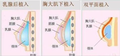 假体隆胸假体置入部位