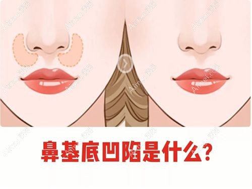 鼻基底填充用什么材料比较好？膨体or舒铂哪个成效更好？