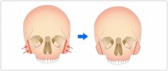 什么是颧骨颧弓整形术_效果怎么样