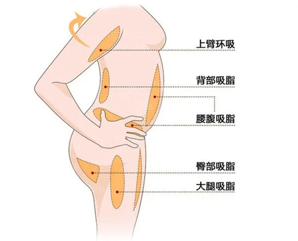 吸脂部位