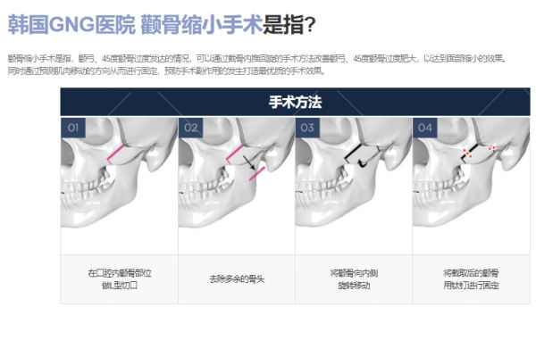 韩国轮廓哪里做得好?当地亲评韩国gng整形医院轮廓三件套绝绝子!