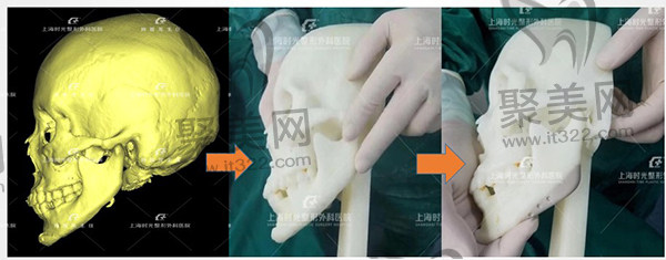 上海时光何晋龙下颌角截骨修复