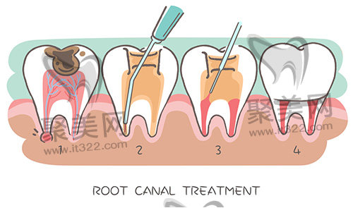 根管治疗