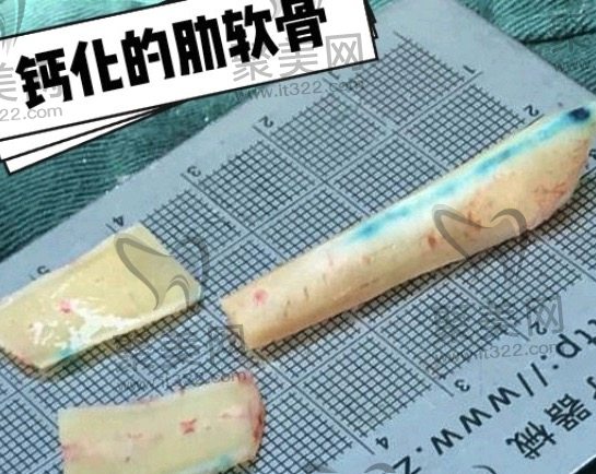 隆鼻修复要多久才能二次修复？