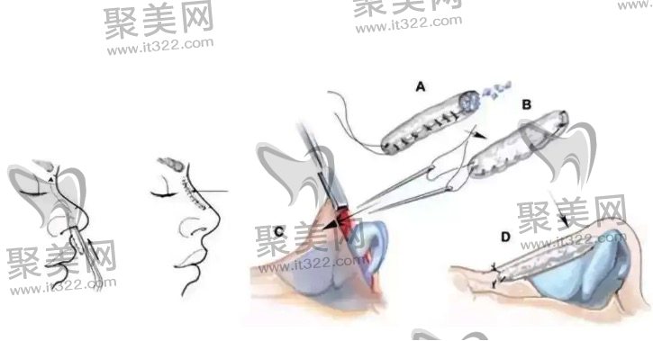 隆鼻过程