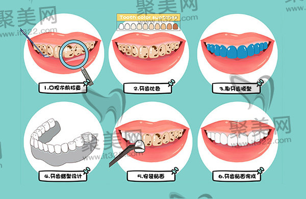 牙齿贴面流程示意