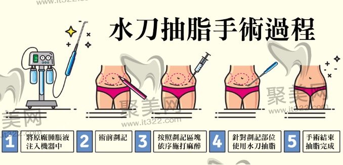 影响局部抽脂手术价格因素