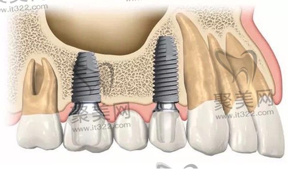 如何选择正规医院进行种植牙治疗