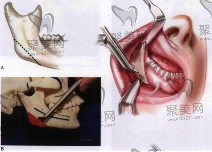 下颌角切除的真实经历