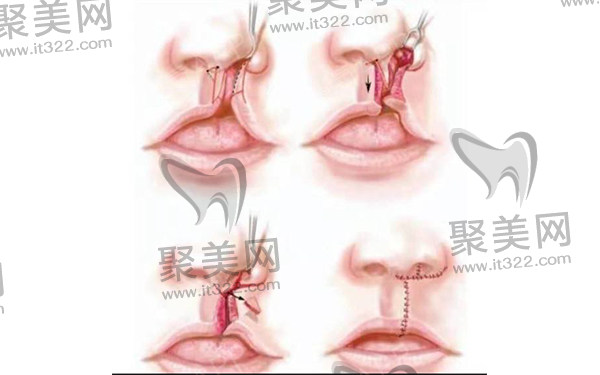 赵绛波唇腭裂修复