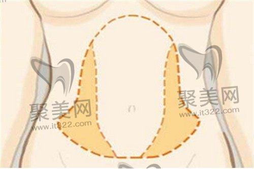 腹部吸脂肪会反弹吗？真诚求问做吸脂肚子真的明显瘦吗？