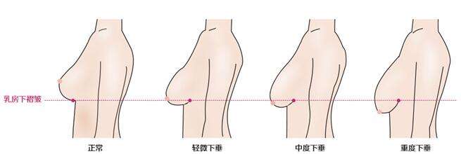 乳房下垂矫正手术真的有*果吗？