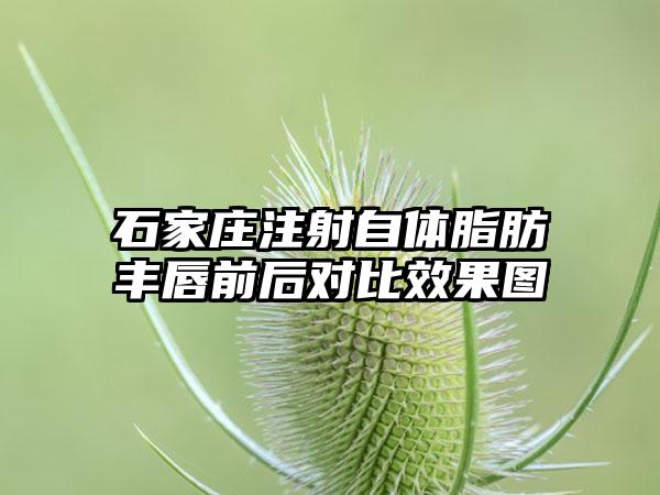 石家庄注射自体脂肪丰唇前后对比效果图