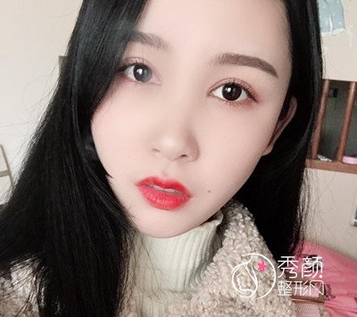 上海华美杨亚益割双眼皮开眼角恢复过程，7mm扇形真的很适合我！