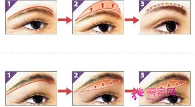 做提眉手术后,眼会变漂亮吗？只有这些眼型才可以做！科普大全