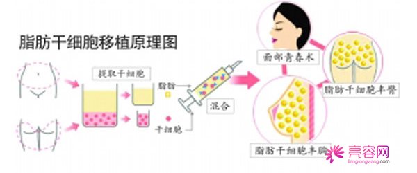 自体脂肪填充后遗症有哪些？要怎么避免这些情况呢？面部填充案例