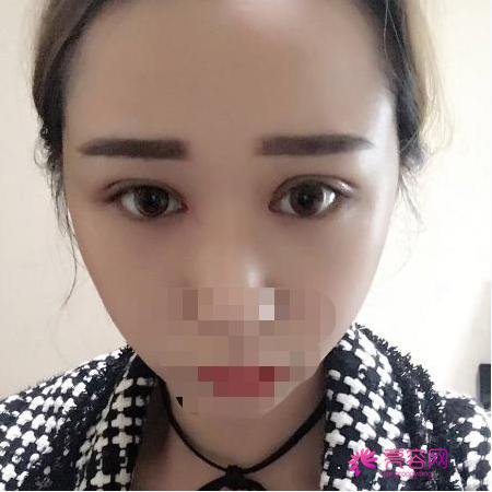 西安晗美整形徐艳眼部手术怎么样？医生信息简介+真人案例体验分享