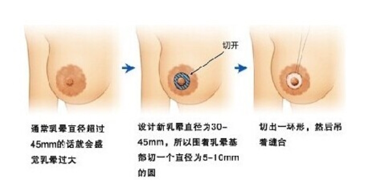 咱们来聊聊乳晕整形需要多少钱 乳晕整形术会有