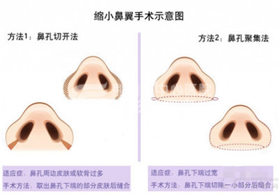 鼻翼缩小，让你自信展现美鼻