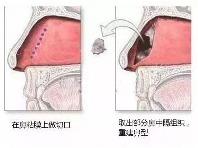 干货科普|自体软骨隆鼻到底好不好？