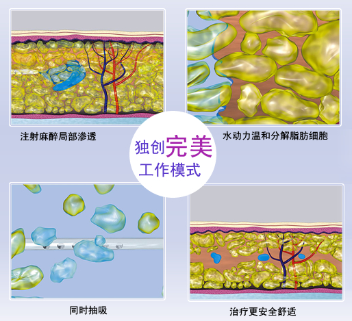 吸脂手术的优点有哪些