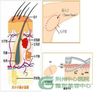 宜昌哪里治疗腋臭*好？