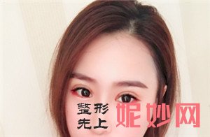 到北京正美找郑永生做眼部修复的效果怎么样？术后42天眼睛好看很多