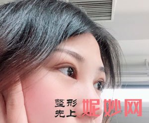 到北京美莱医疗美容找叶宇做眼部多项怎么样？术后50真人案例分享