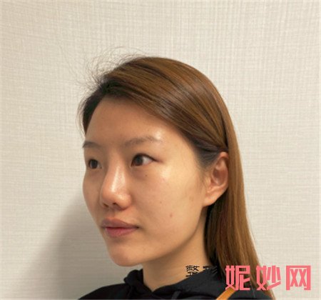 到北京大学人民医院整形外科找杨锴做的切开双眼皮,术后眼睛好看很多