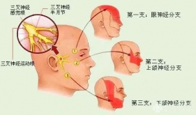 三叉神经痛病因及治疗