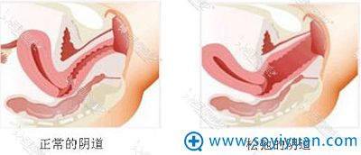 韩国好手艺妇科医院阴道紧缩术