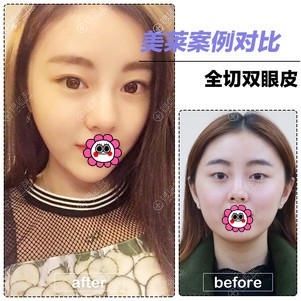 北京美莱双眼皮效果怎么样？