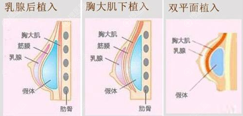 假体隆胸植入层次示意图