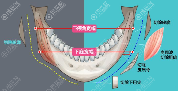 下颌角整形示意图