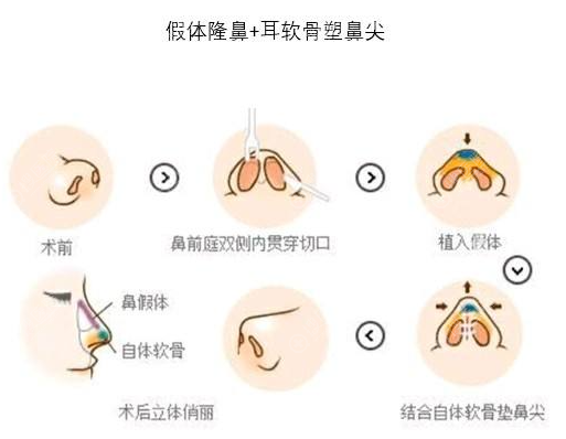 膨体+耳软骨隆鼻示意图