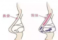 假体隆鼻出现排异现象，取出后还能再次做肋骨鼻吗？