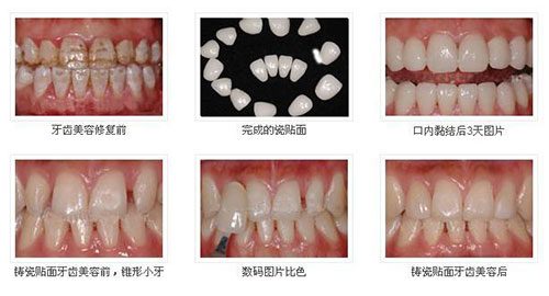 牙齿美白示意图