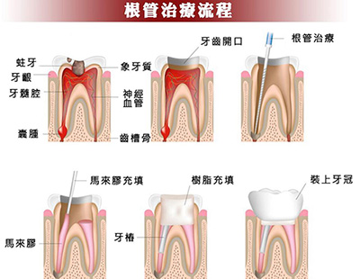 根管治疗修复过程照片